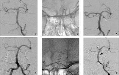 Endovascular Treatment of Posterior Circulation Saccular Aneurysms With the p64 Flow Modulation Device: Mid-and Long-Term Results in 54 Aneurysms From a Single Center